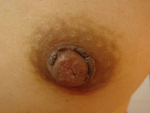 Squmaous cell papilloma or viral wart
