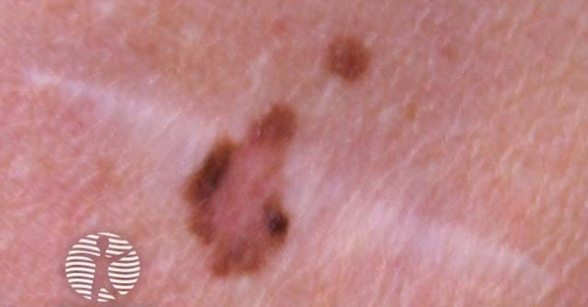 Recurrent naevus image