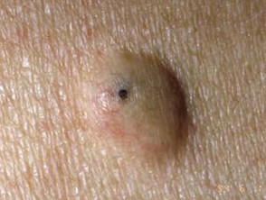 Cutaneous cysts and pseudocysts | DermNet NZ