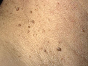 Acrochordon or skin tag near armpit Stock Photo