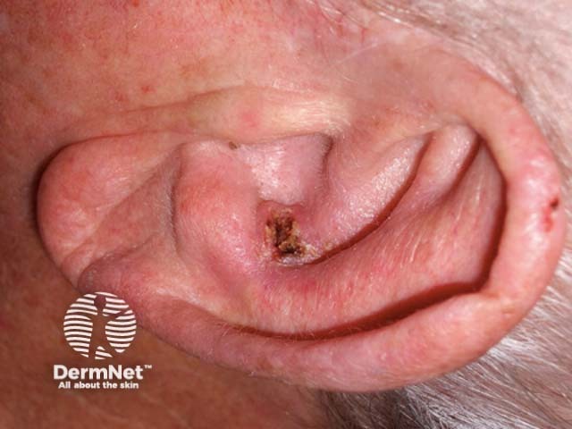 An ulcerated squamous cell carcinoma in the ear
