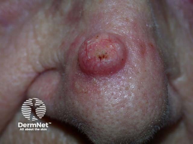 Squamous cell carcinoma of the nose