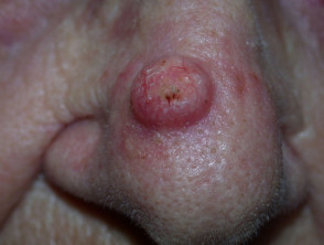 Squamous cell carcinoma of the nose