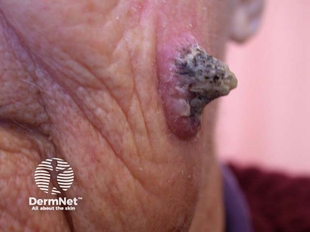 Squamous cell carcinoma on the face