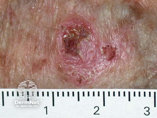 Intraepidermal carcinoma