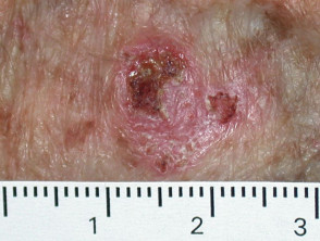 Intraepidermal carcinoma