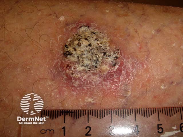 Squamous cell carcinoma of limbs
