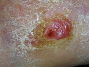 Squamous cell carcinoma of limbs
