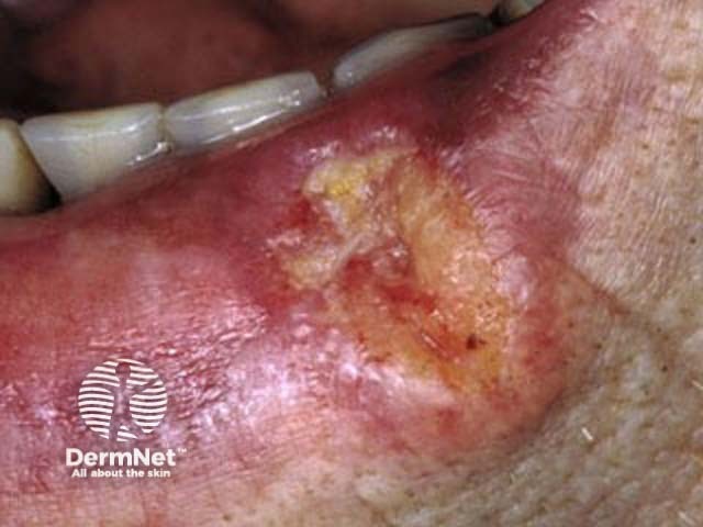 A firm ulcerated squamous cell carcinoma on the lower lip