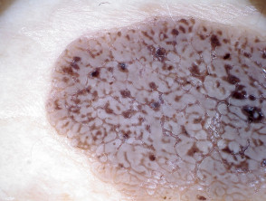 Seborrhoeic keratosis cerebriform pattern on dermatoscopy
