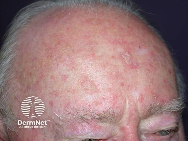 Field change over the forehead with multiple superficial actinic keratoses