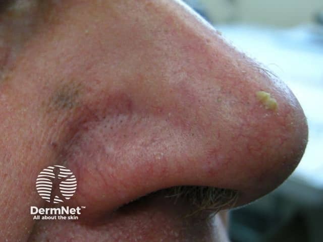 Actinic keratoses on the nose