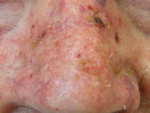 Actinic keratoses on the nose