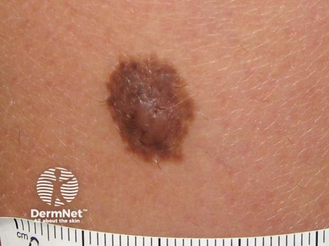 Moles melanocytic Naevi Pigmented Nevi Moles melanocytic Naevi Pigmented Nevi