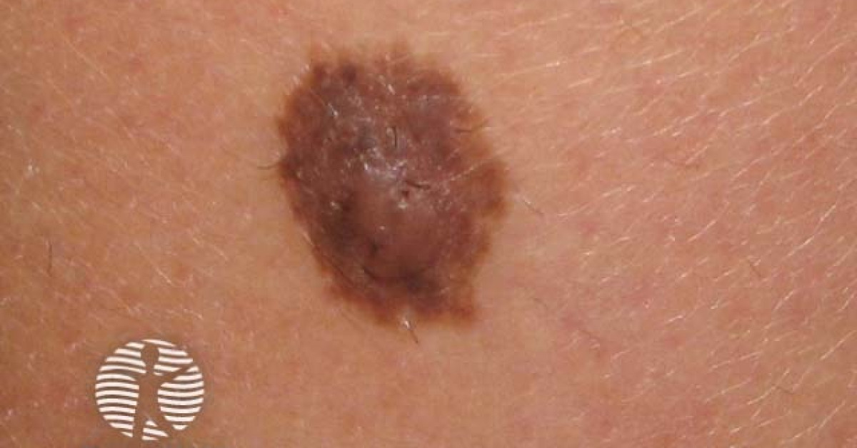 Congenital naevus image
