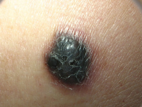Spitzoid melanoma on the arm of an adult