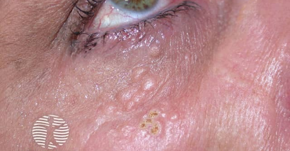 syringoma image