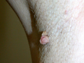 Skin Tag Or Acrochordon Or Soft Fibroma Or Mole In Male Armpit