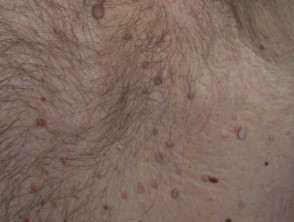 Skin Tag Or Acrochordon Or Soft Fibroma Or Mole In Male Armpit