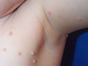 Closed Up of Skin Tags or Acrochordon Under the Armpit Stock Photo