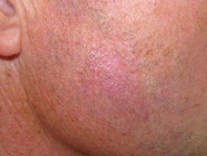 Superficial basal cell carcinoma, face