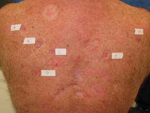 Superficial basal cell carcinoma, back