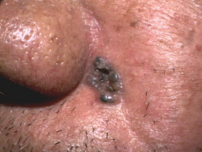 Nodular basal cell carcinoma