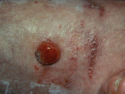 Nodular melanoma