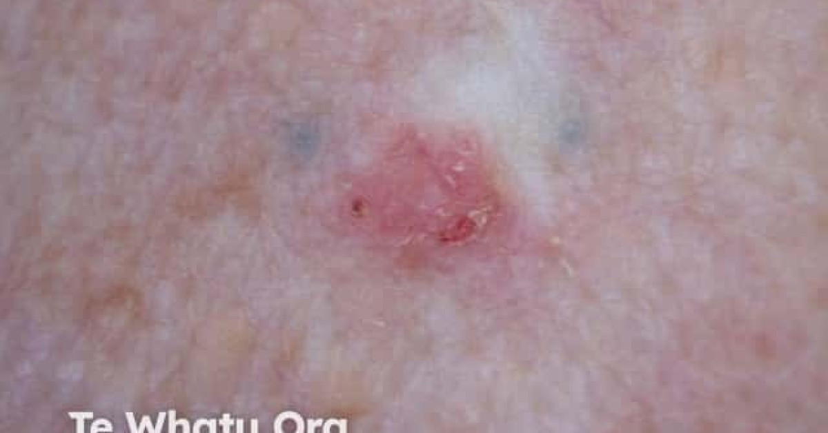 DermNet® - Basal cell carcinoma recurrent after topical fluorouracil image