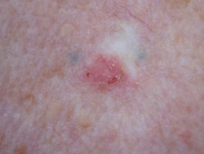 Basal cell carcinoma recurrent after topical fluorouracil