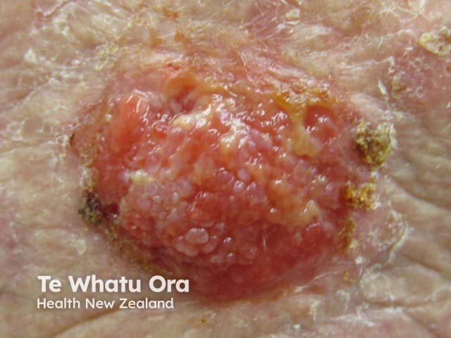 High-risk cutaneous squamous cell carcinoma