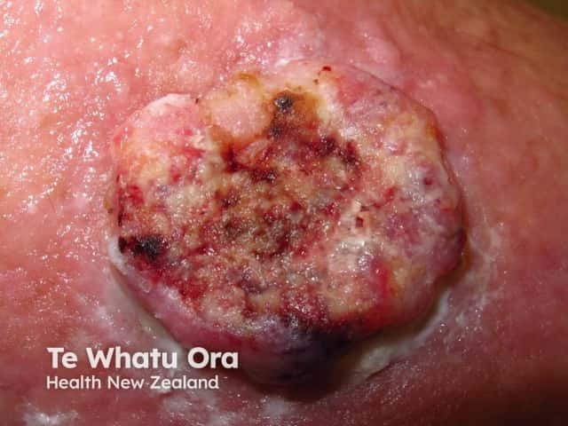 High-risk cutaneous squamous cell carcinoma