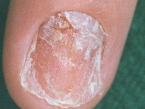 Nail dystrophy due to lichen planus