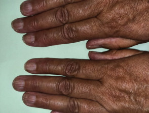 Nail dystrophy due to lichen planus