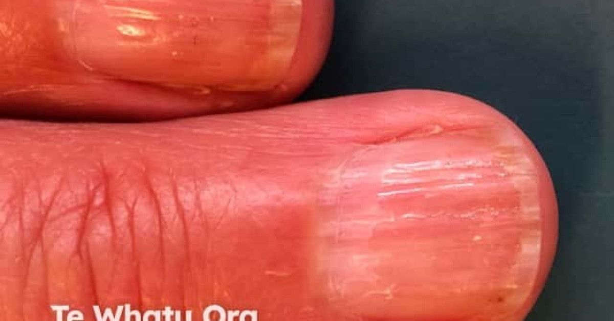 Nail dystrophy due to lichen planus image