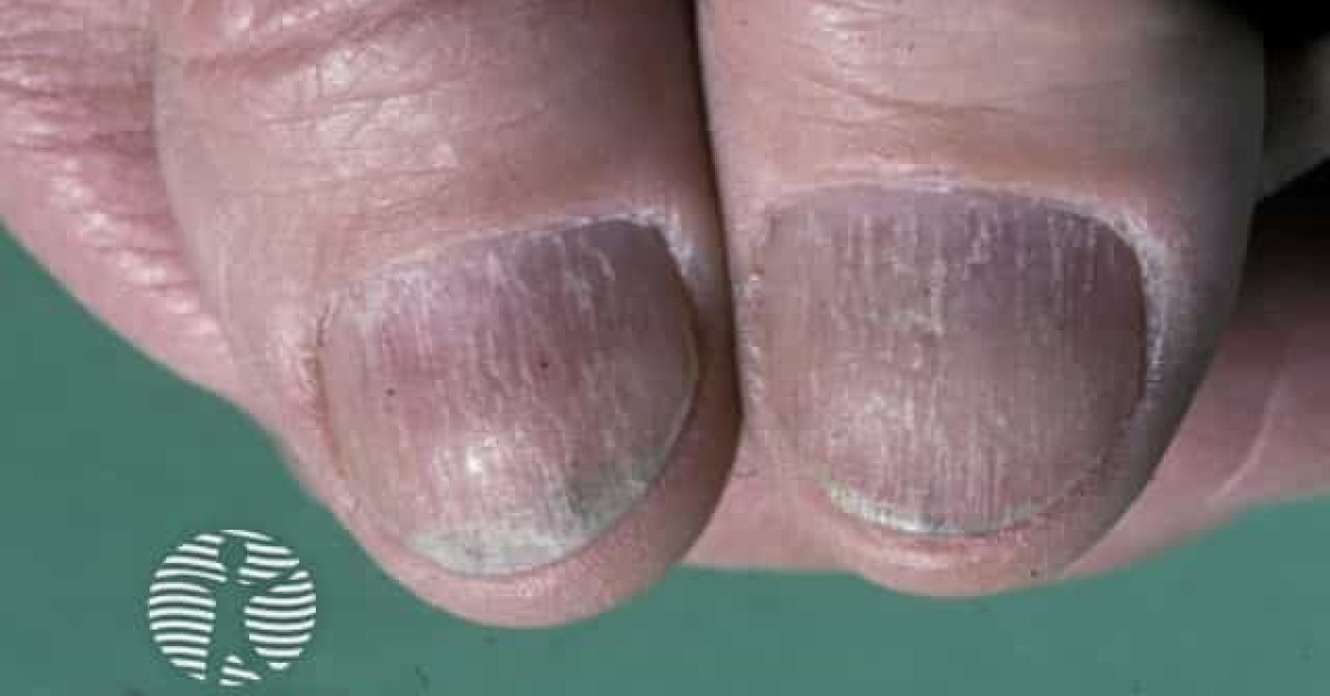 Nail dystrophy due to lichen planus image