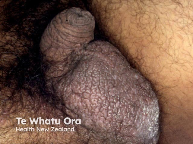 Lichen simplex scrotum