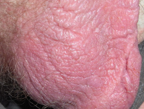 Scrotum red bump on Causes and
