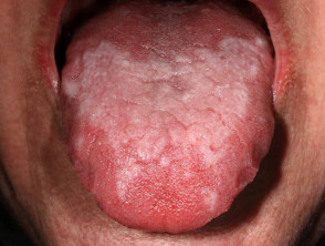 Lichen planus of tongue plaque pattern