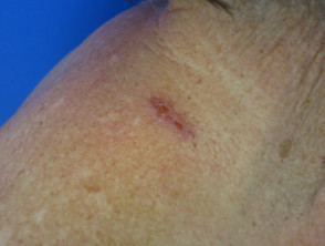 Linear basal cell carcinoma