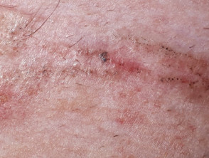 Linear pigmented basal cell carcinoma