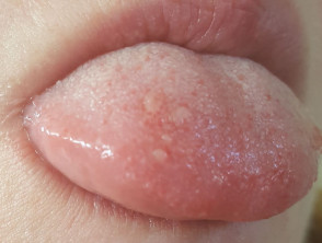 Tongue water blister under Blisters on