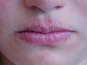 Eczema on the Lips: Causes, Symptoms & Treatment