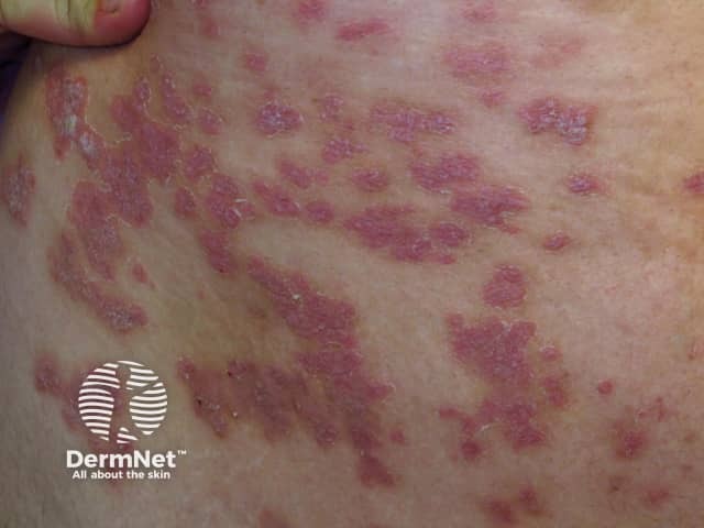 Psoriasis induced by lithium