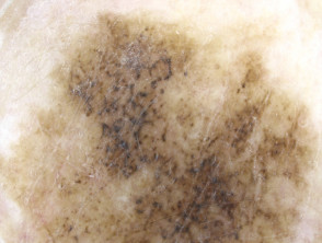 Annular granular pattern and rhomboids seen in dermoscopy of lentigo maligna melanoma