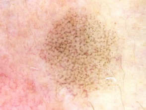 Annular granular pattern seen in dermoscopy of lichen planus-like keratosis