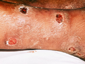 Lucio phenomenon in leprosy