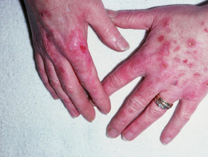 Discoid lupus erythematosus affecting dorsal hands