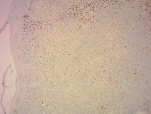 Lymphomatoid papulosis pathology stained with CD8x40