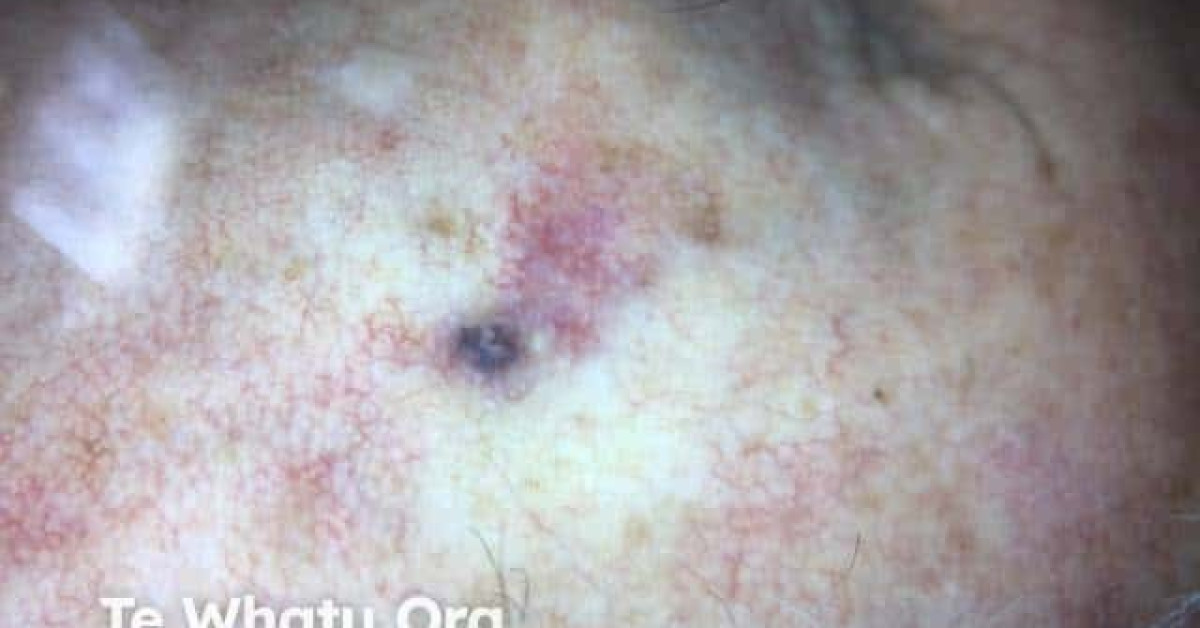 Basal Cell Carcinoma Image